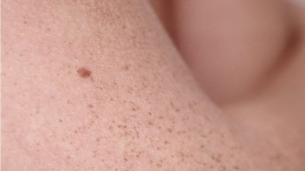 mole predicts skin cancer