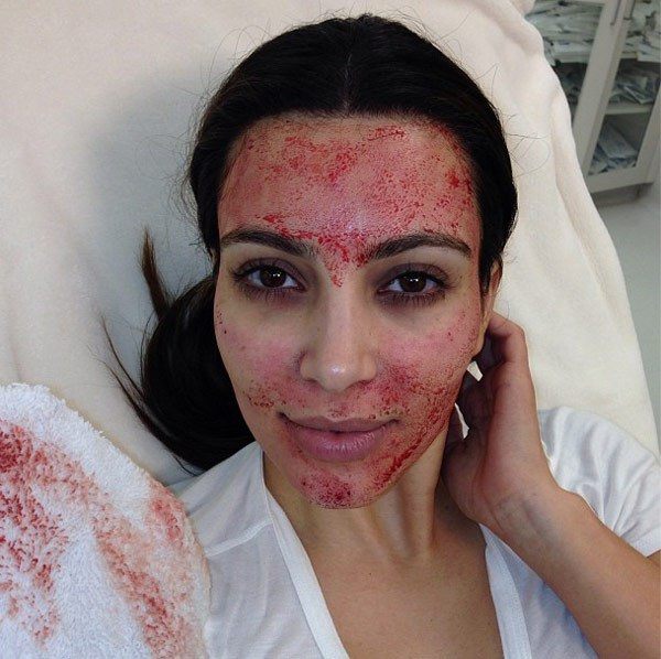 Kim Kardashian’s Bloody Face